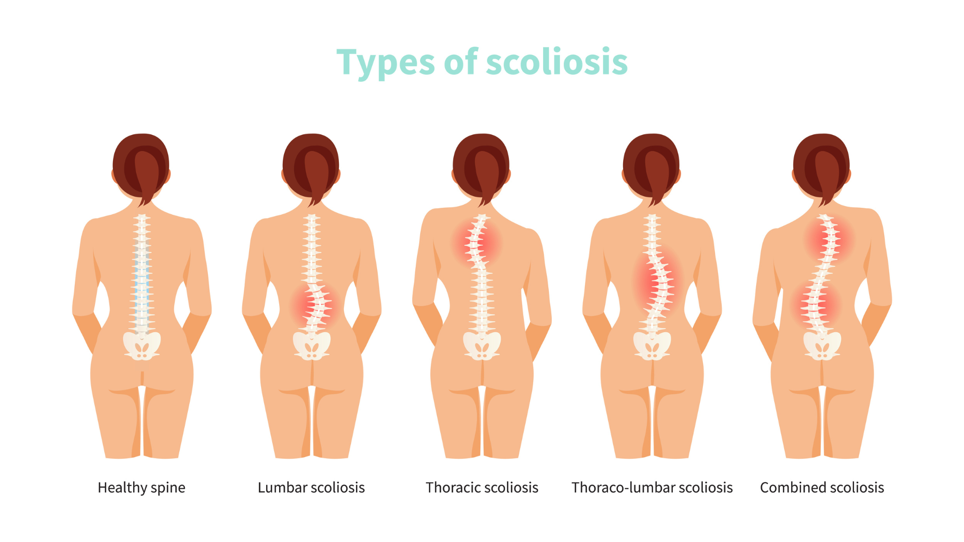 Female anatomy with different types of scoliosis. Medical vector illustration
