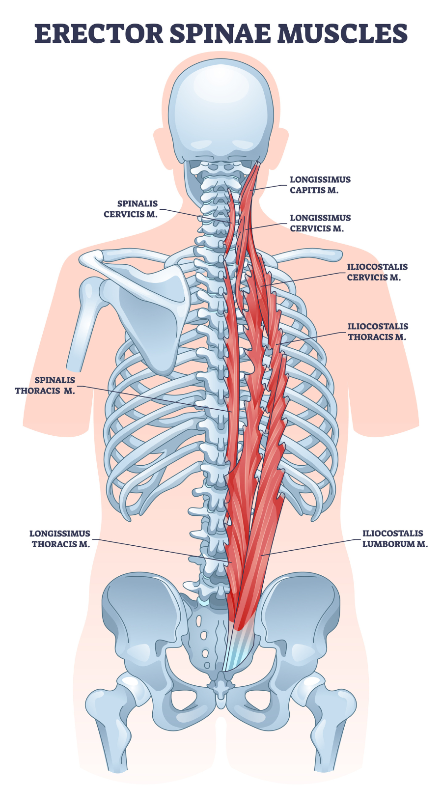 Erector spinae muscles with human back muscular system outline diagram. Labeled educational scheme with vertebrae lateral, column or medial parts division vector illustration. Title Text: Scoliois and the importance of the Erector Spinae Muscles 