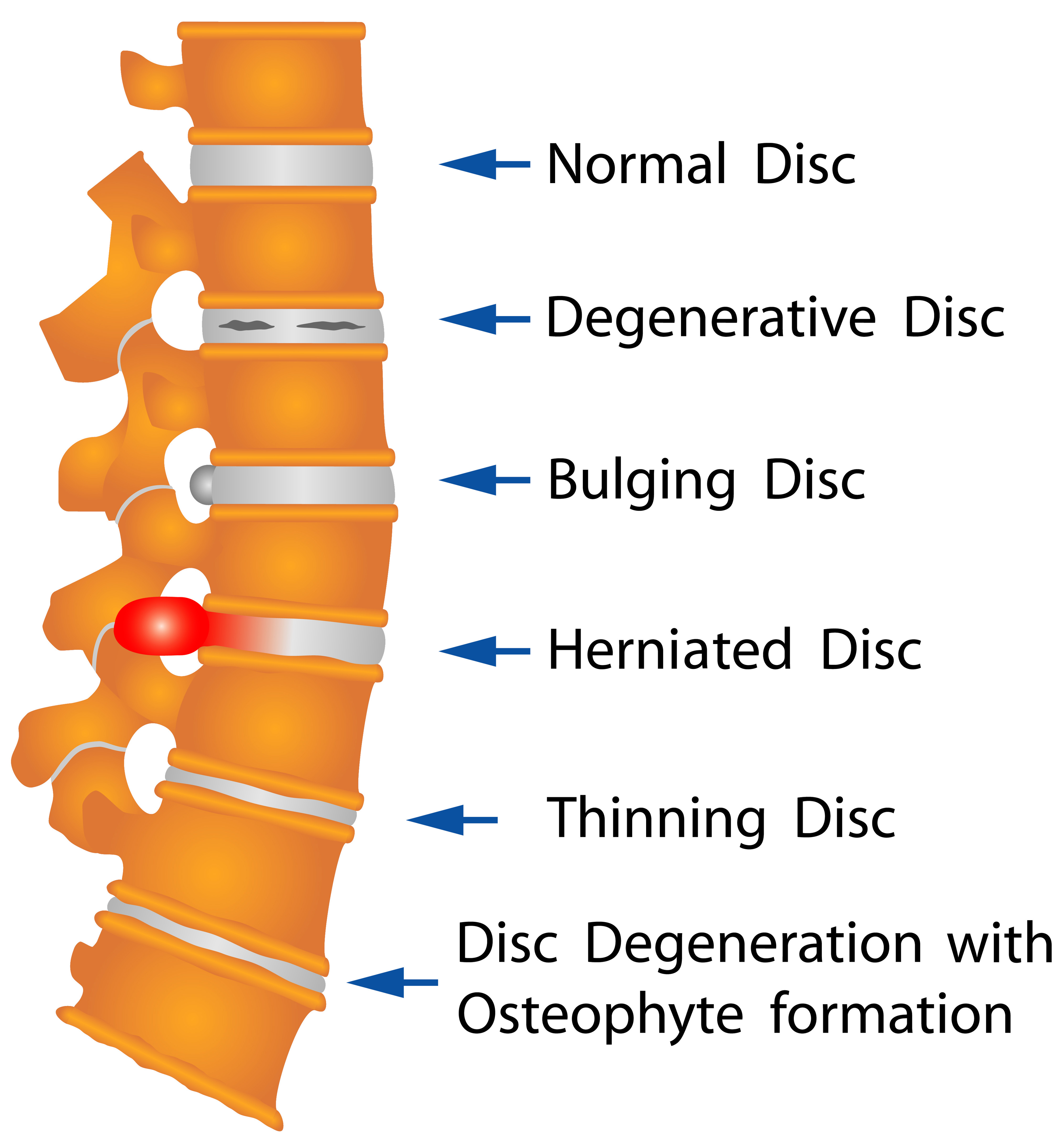 Degenerative Disc Disease Anatomy Image