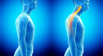 forward head posture