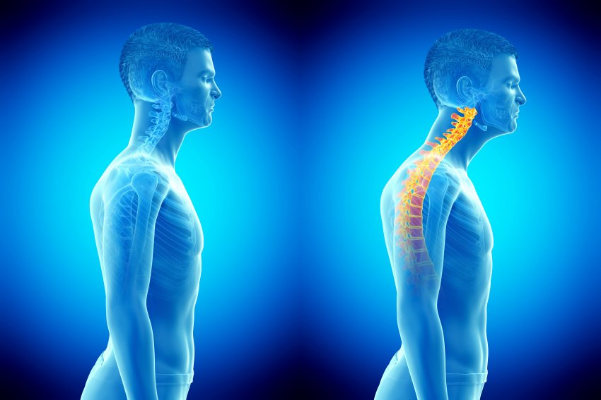 forward head posture
